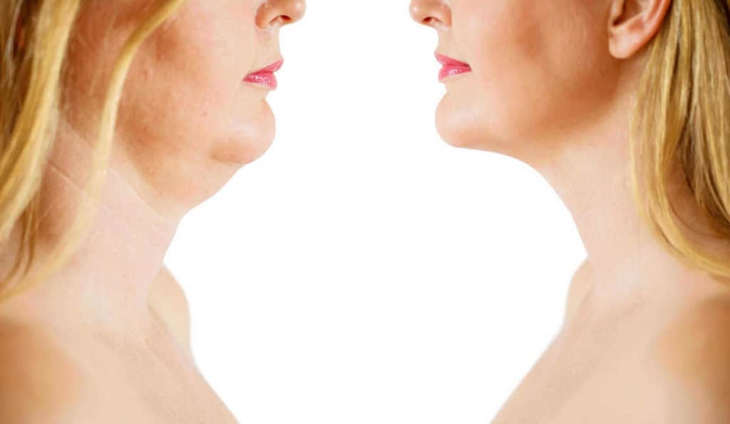Double Chin treatment Chippenham before and after results