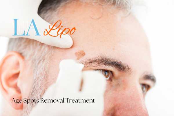 What Are the Most Effective Treatments for Age Spots Chippenham?