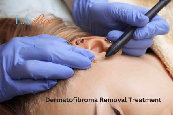 Dermatofibroma Removal Treatment Chippenham