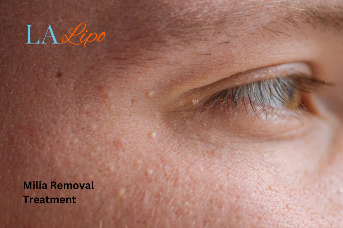 Cryopen Milia Removal: Is It the Easiest and Safest Option Chippenham?