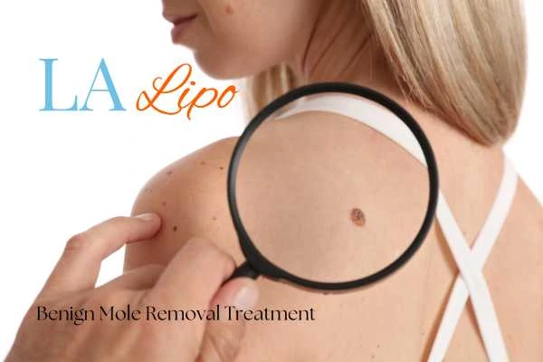 Woman having her inspection of blemish before mole removal Chippenham