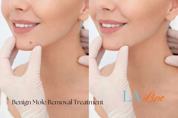 woman's before and after mole removal Chippenham results