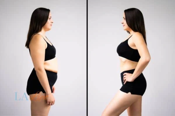 image of woman before and after results of LA-EMS Body Sculpting Chippenham to help treat Diastasis recti