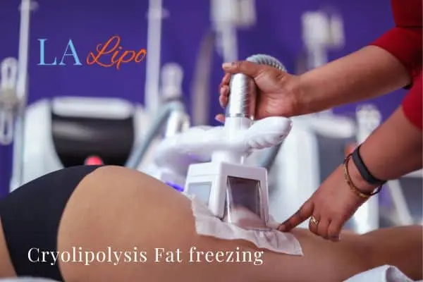 women getting fat freezing Chippenham