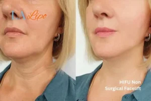 hi-fu for wrinkles Chippenham before and after results