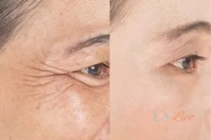 Before and after results of woman - HI-fu wrinkles reduction treatment Chippenham