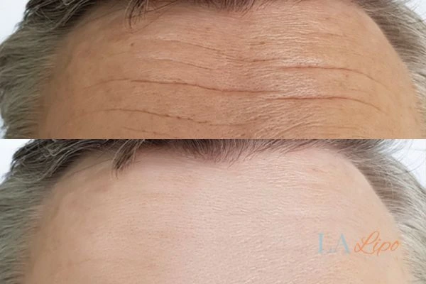 results of HIFU Chippenham on mans forehead to help reduce lines and wrinkles