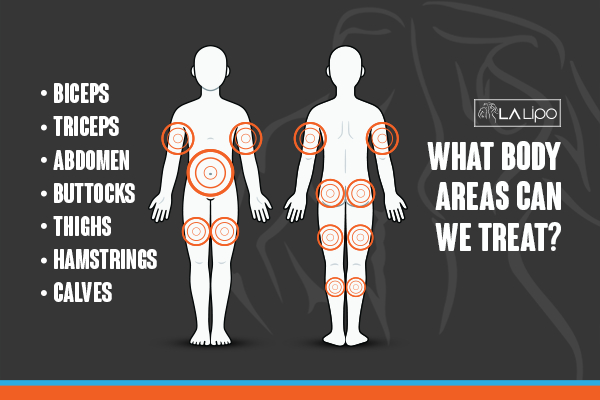 Graphic to show areas you can have LA-EMS Body Sculpting Chippenham treatment.