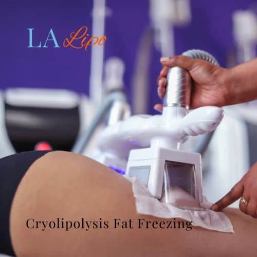 fat freezing - Cryolipolysis Chippenham