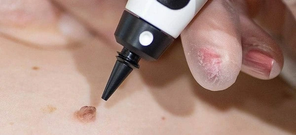 skin tag removal using cryopen Chippenham