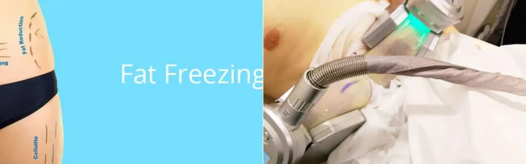 multi areas of a persons body having coolsculpting Chippenham treatment