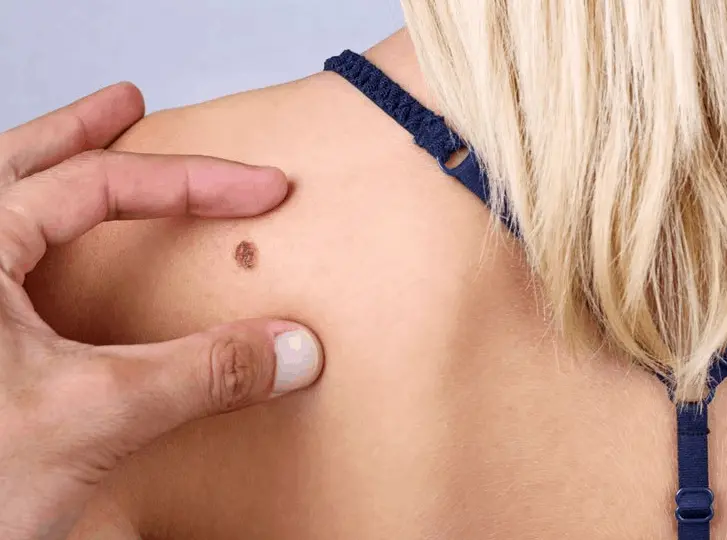 woman having mole removal Chippenham consultation before treatment.