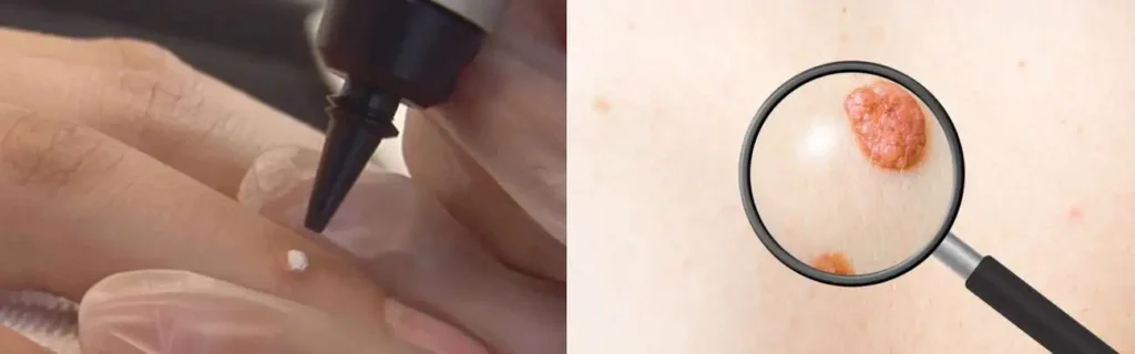 Cryopen for mole removal Chippenham - speak to our team today!