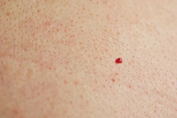 close up of a cherry angioma Chippenham