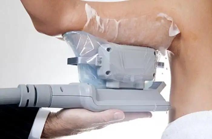 Picture of fat freezing Chippenham on the upper arms.