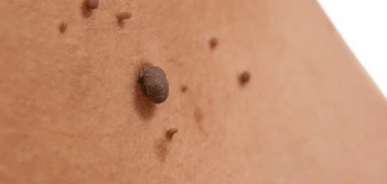 image of a skin tag Chippenham