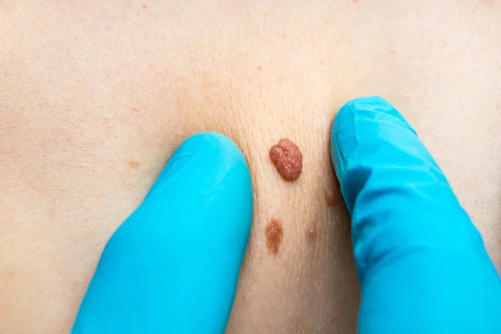 Consultant examining a skin tag Chippenham