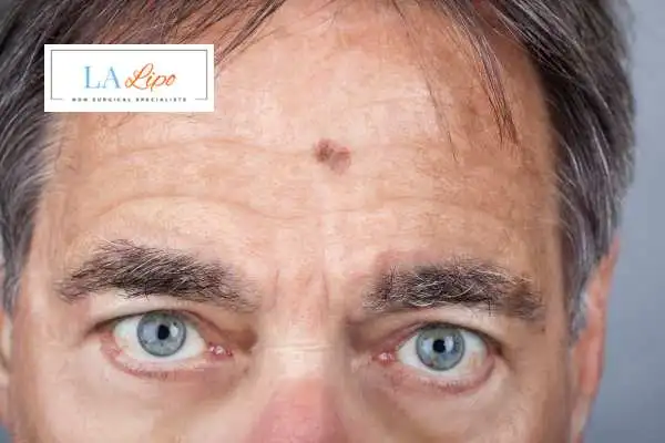 Solar Lentigo Removal Chippenham image of man with mark on his forehead