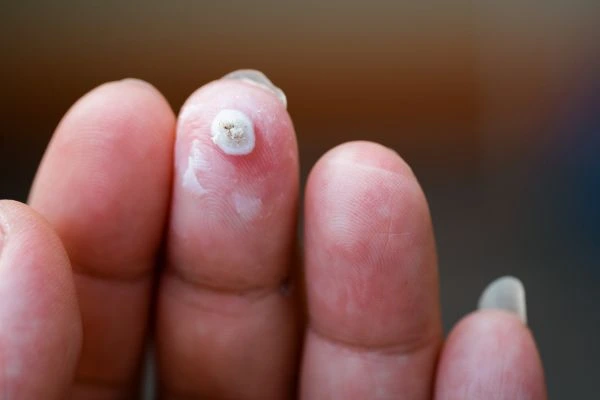 wart on person finger - cryotherapy to treat from LA LIPO Chippenham