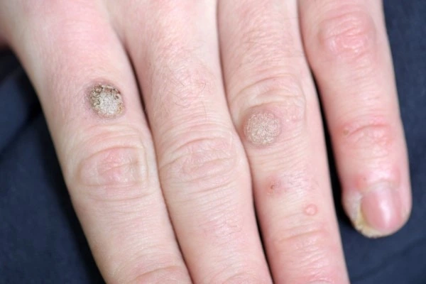 photo of warts on person hand - see wart removal Chippenham from LA LIPO