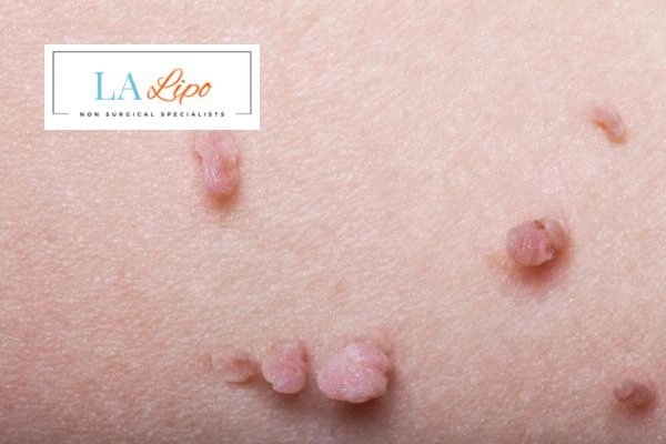 Does cryopen skin tag removal Chippenham hurt? Find out now call our team today!