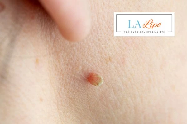 Book skin tag removal Chippenham today speak to our team now!