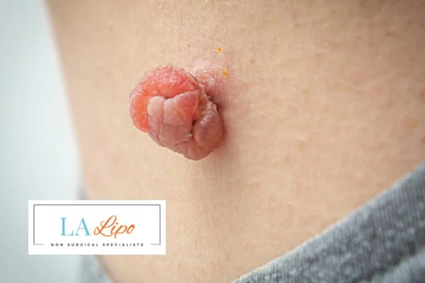 Interested in skin tag removal Chippenham? Concerned about the pain? Find out more today!