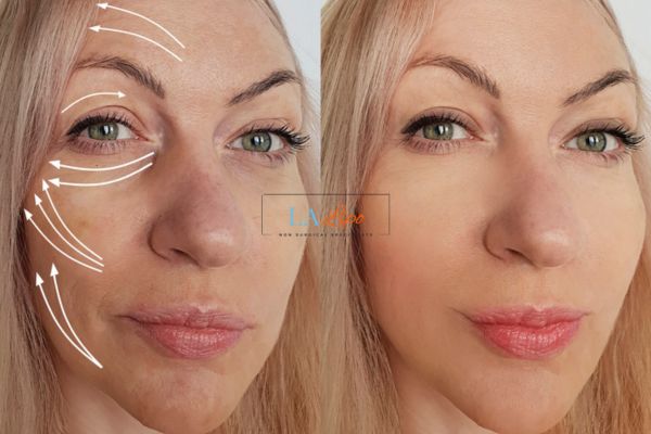 Morpheus 8 results Chippenham face lift.