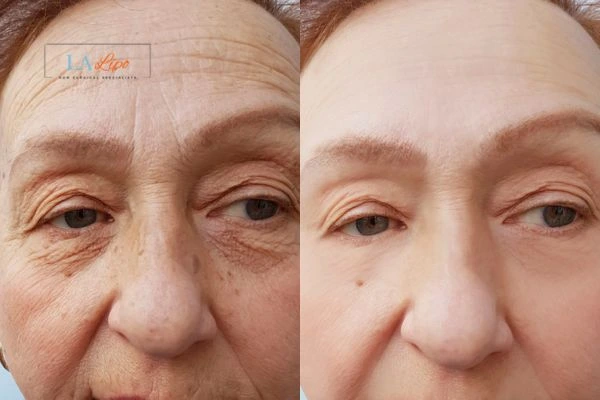 The powerful benefits of Morpheus8 Treatment Chippenham - Call Our team today!
