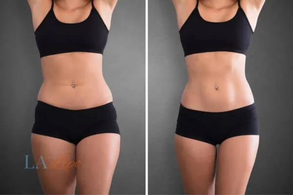 before and after results of non-surgical treatment to help a woman's body image and mental health Chippenham