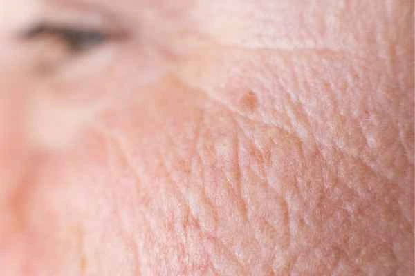 close up picture of a woman's face showing an age spot Chippenham