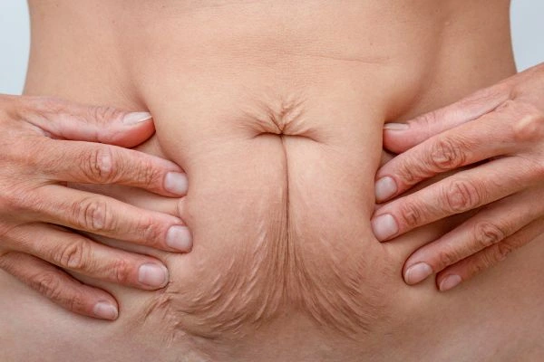Image of a woman's stomach with loose skin - example of skin tightening Chippenham options