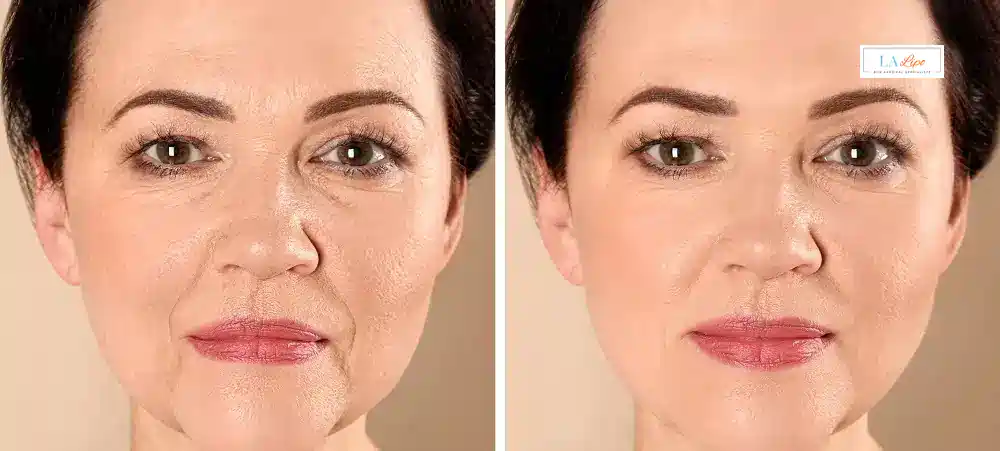 How Long Does It Take to See Results and How Long Do They Last Chippenham?