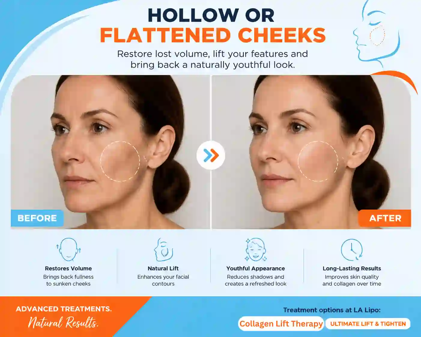 Sign #4: Hollow or Flattened Cheeks Chippenham